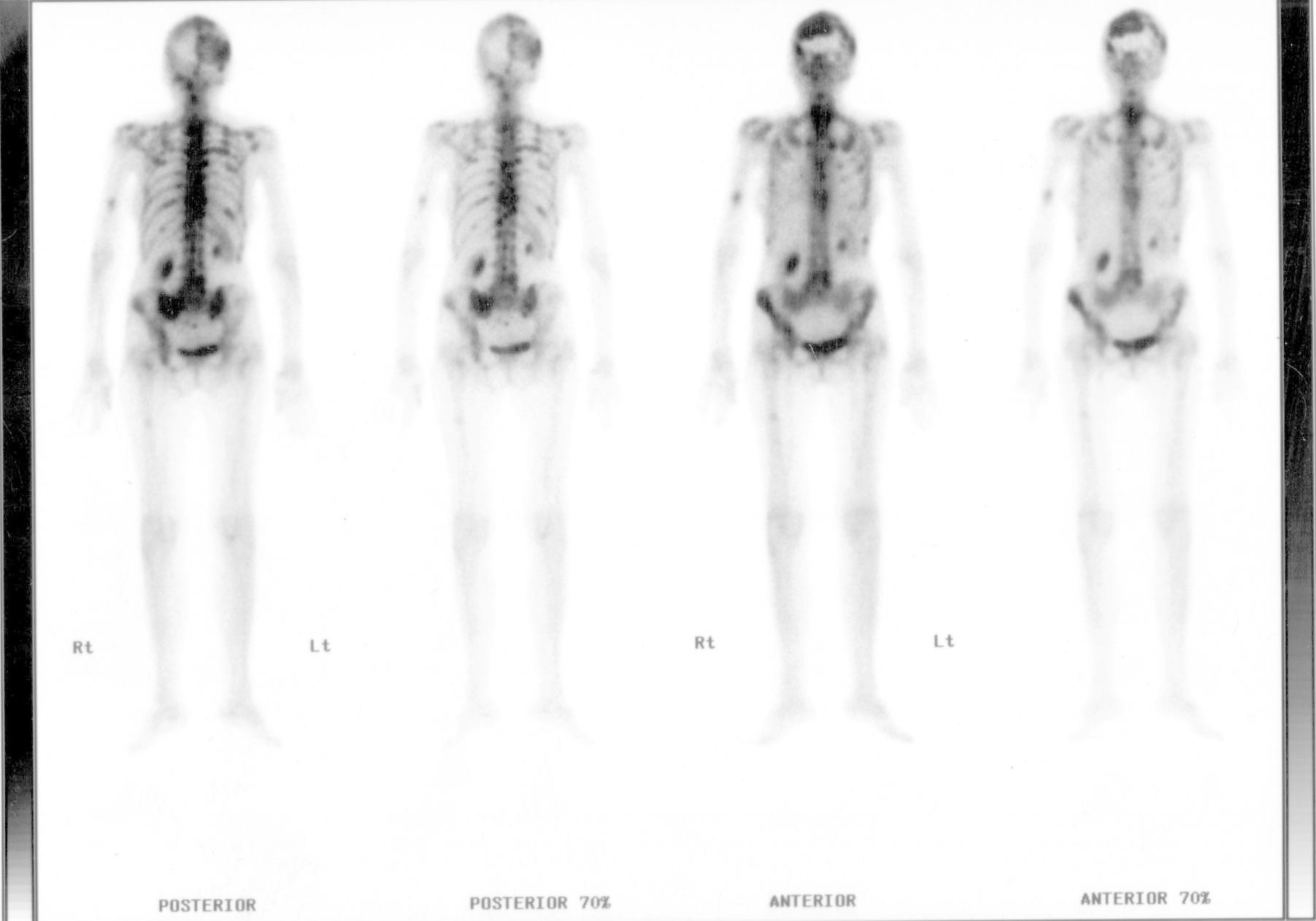 Whole-body Tc-99m MDP bone scan — anterior and posterior projections showing skeletal metastases pattern