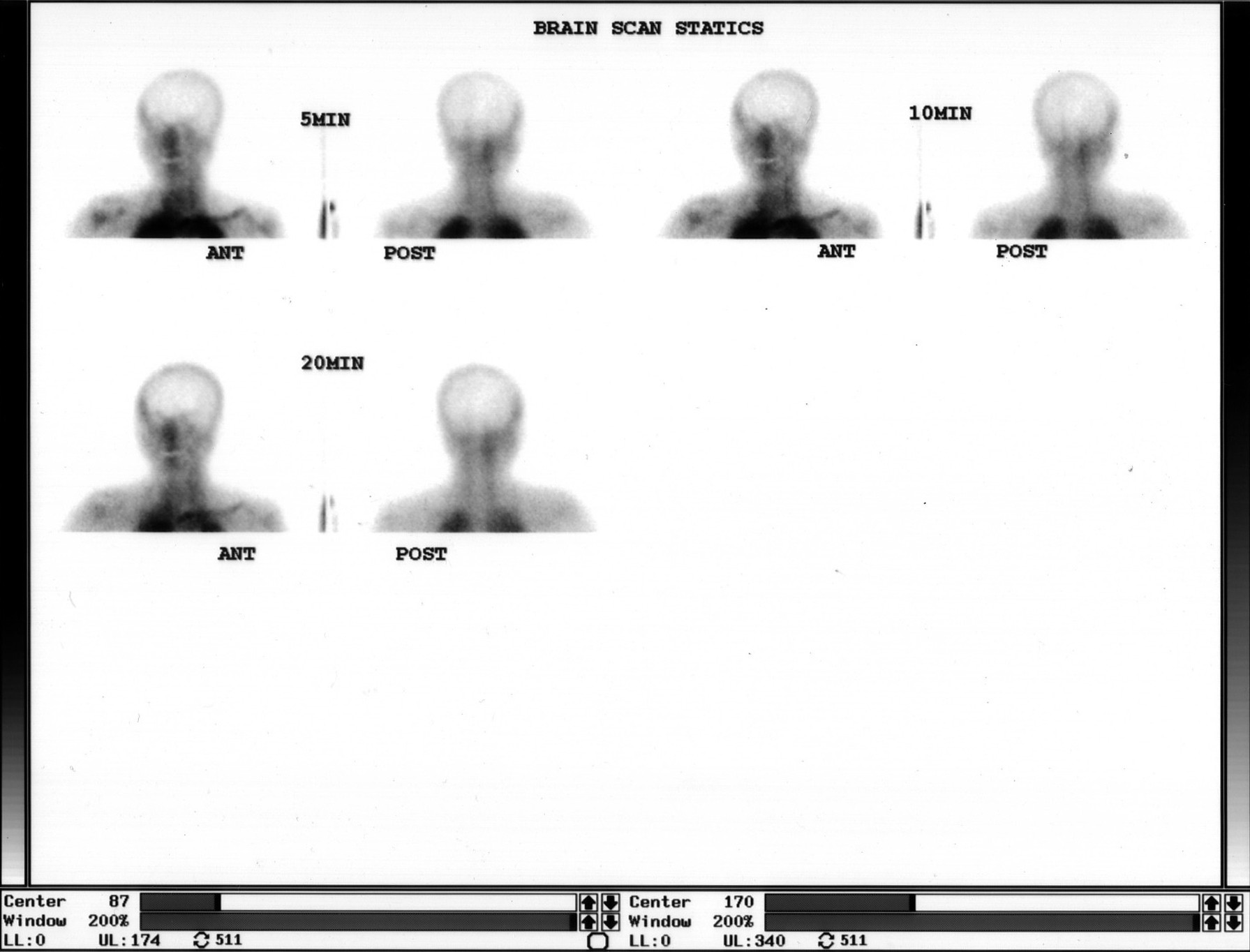 Brain scan statics at 5, 10, and 20 minutes showing absence of cerebral perfusion — only scalp/skull activity visible