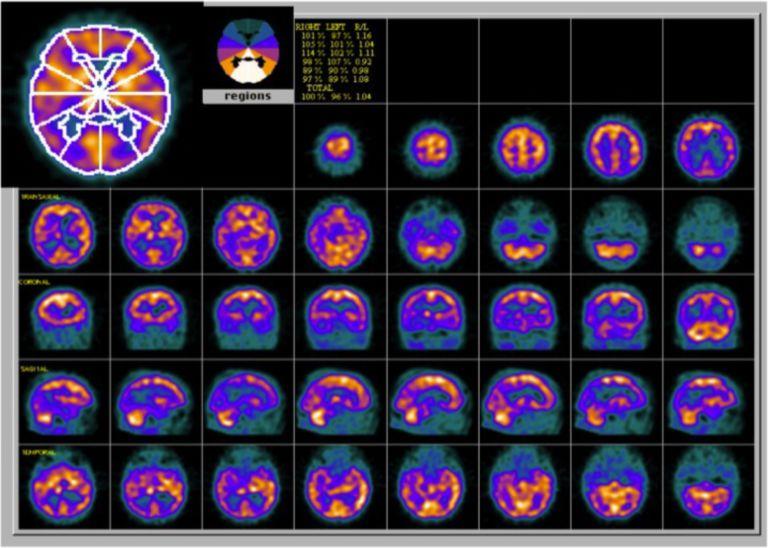 Brain perfusion SPECT — transaxial, coronal, sagittal, and temporal slices showing regional cerebral blood flow pattern in dementia