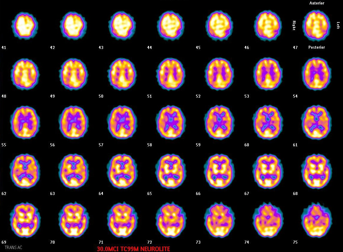 Brain perfusion SPECT (Tc-99m ECD), transverse slices — normal study
