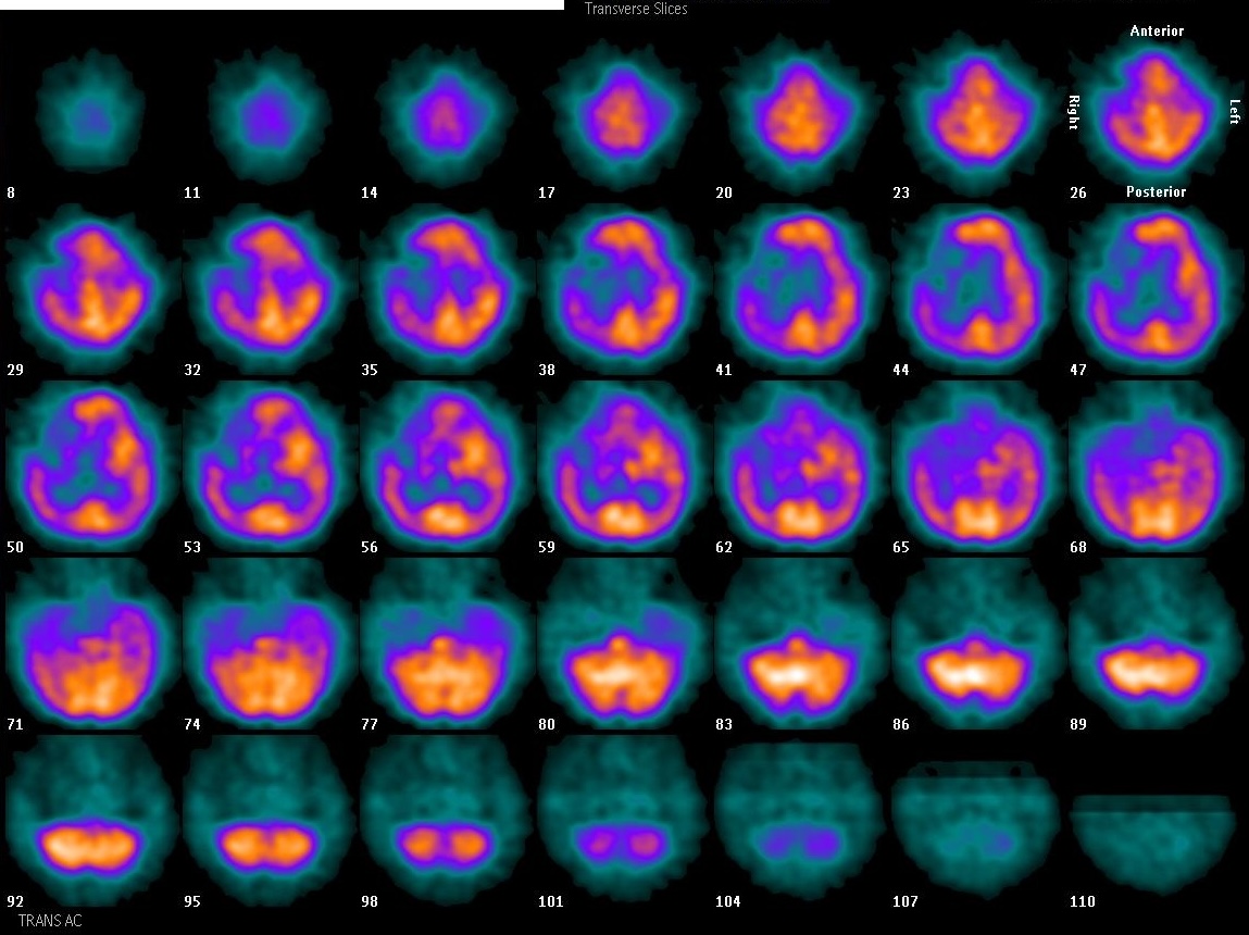Brain perfusion SPECT, transverse slices showing focal perfusion defect