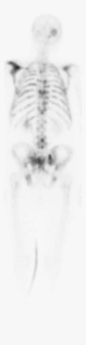 Whole-body Tc-99m MDP bone scan in a patient with prostate cancer