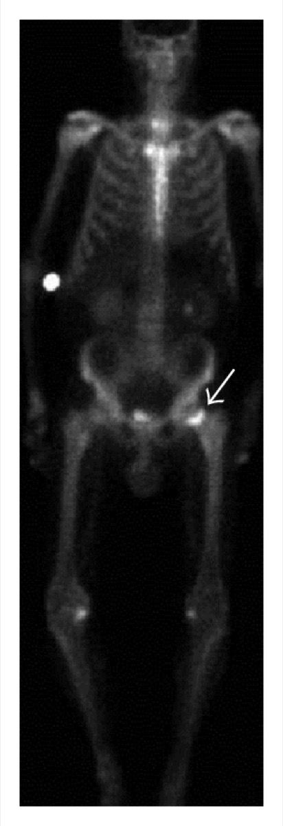 Tc-99m MDP bone scan — femoral head and neck region