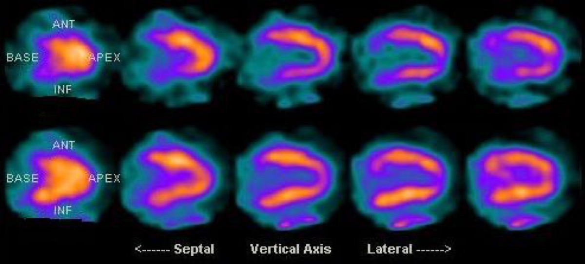 Cardiac SPECT with and without attenuation correction