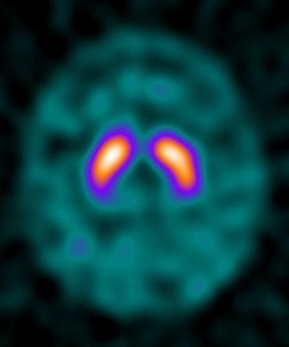 DaTSCAN (I-123 ioflupane) SPECT — midbrain axial slice