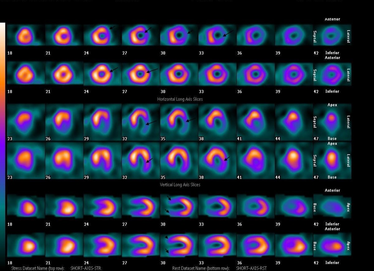Myocardial perfusion SPECT — lateral wall defect present at stress, resolved at rest