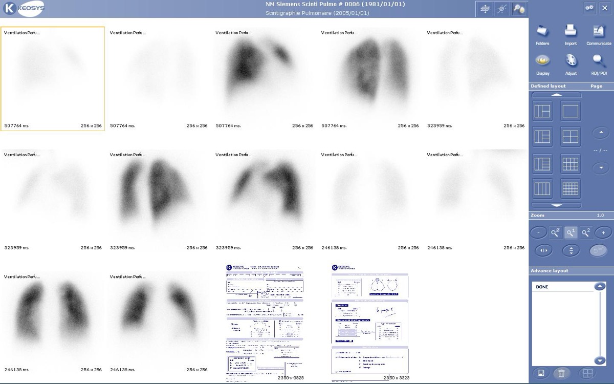 Lung perfusion scintigraphy — multiple views
