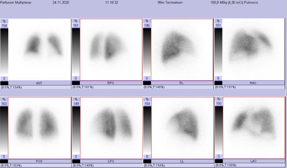 Lung perfusion scintigraphy — normal study (standard projections)