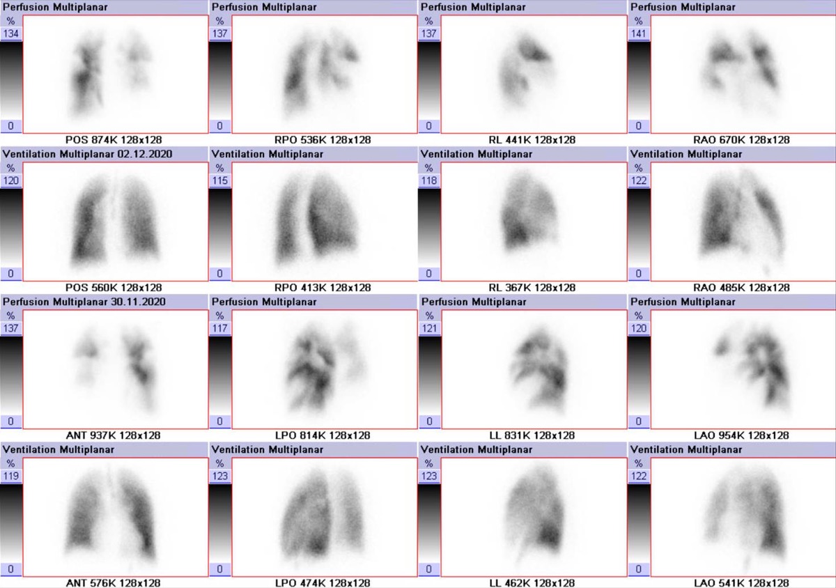 Ventilation-perfusion (V/Q) lung scan — 58-year-old male