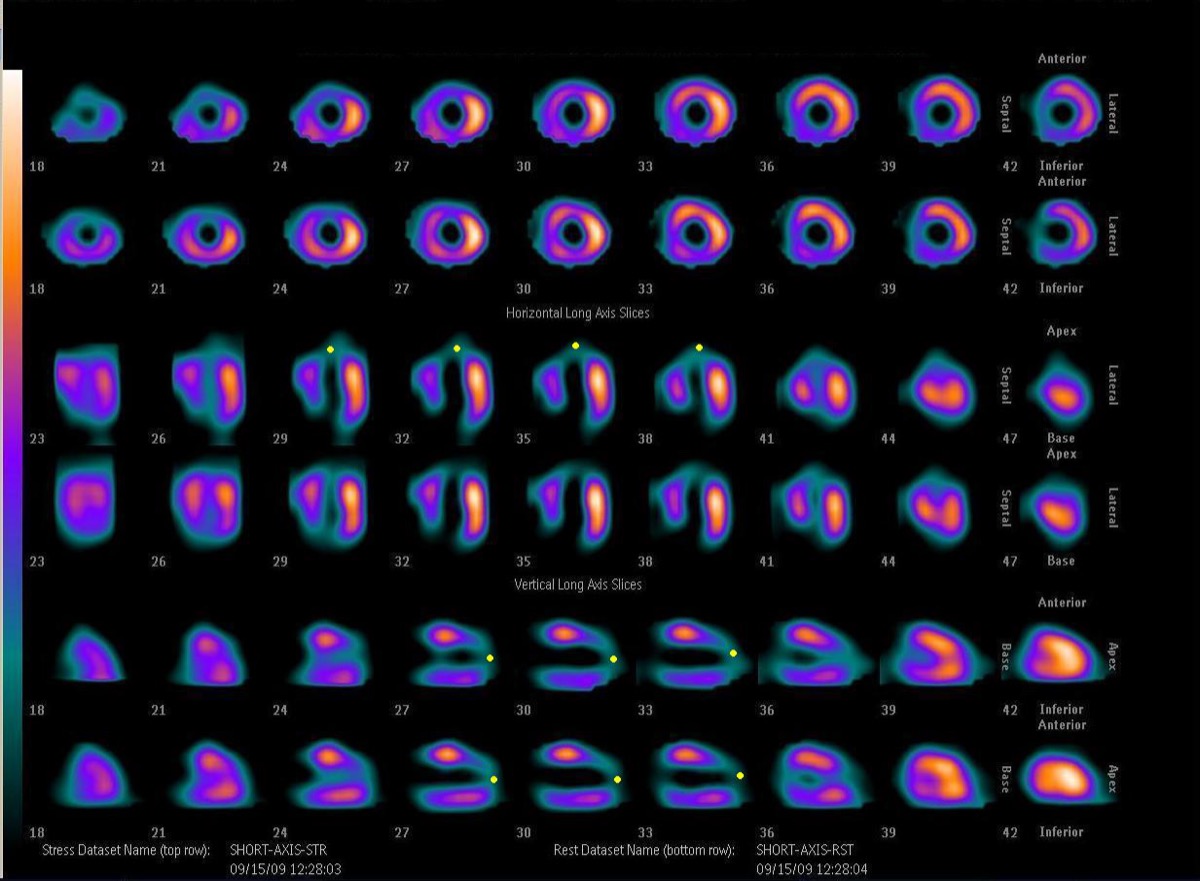 Myocardial perfusion SPECT — anteroapical fixed perfusion defect