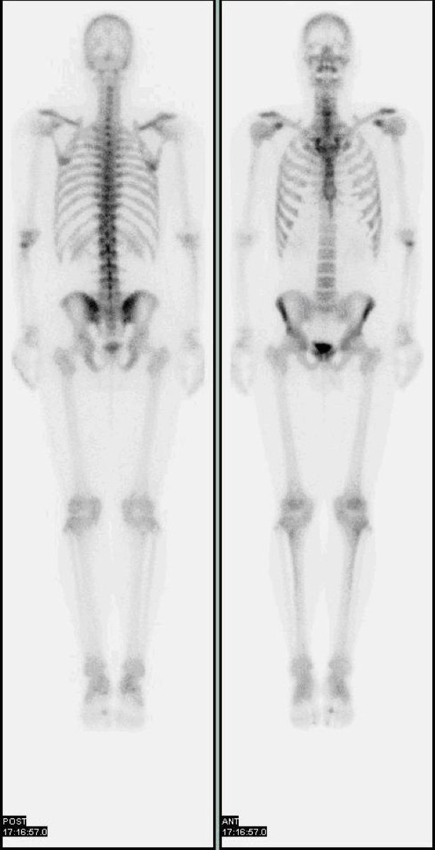 Normal whole-body Tc-99m MDP bone scan — anterior and posterior projections