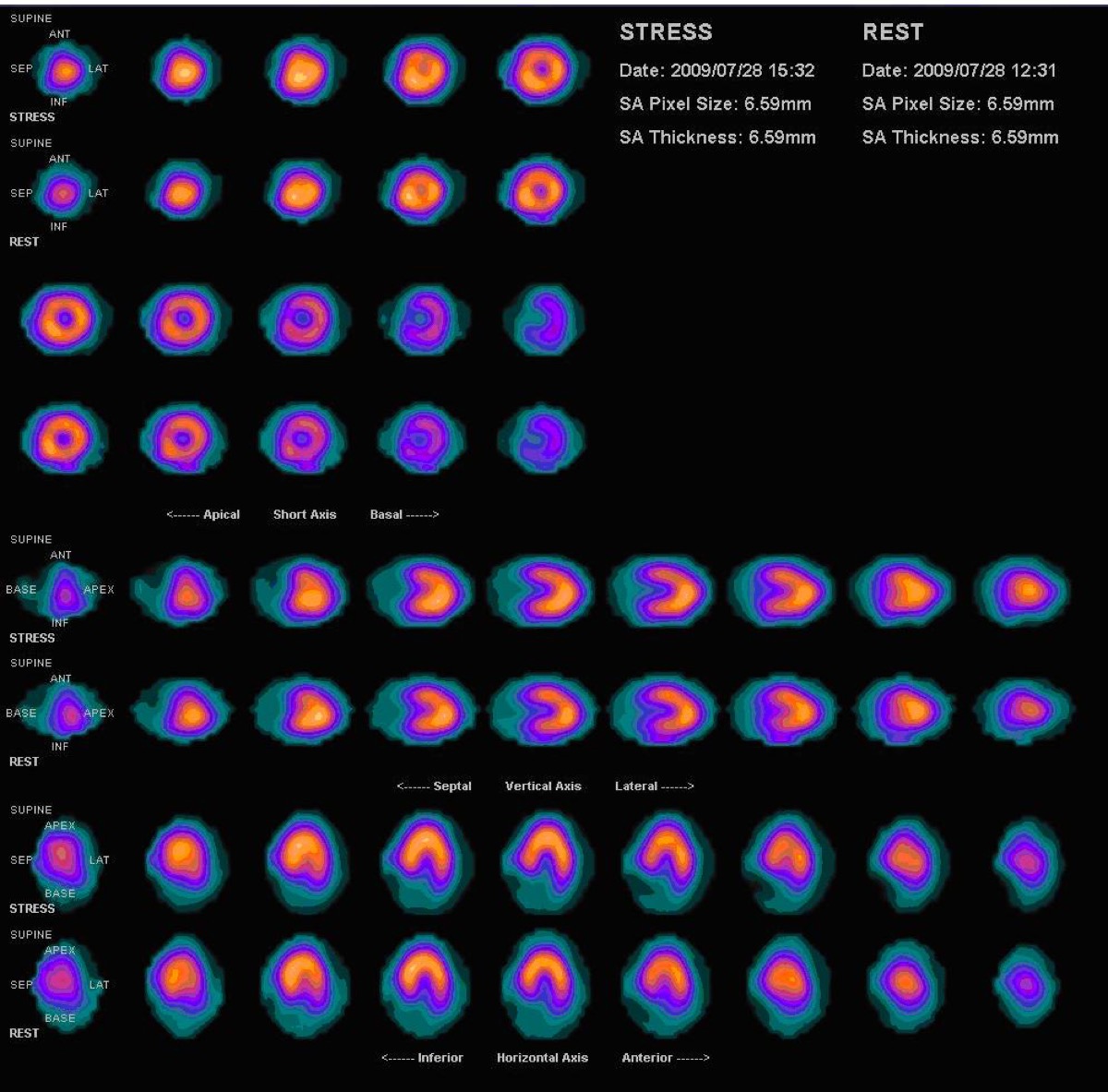 Myocardial perfusion SPECT — polar map (bull's-eye plot)