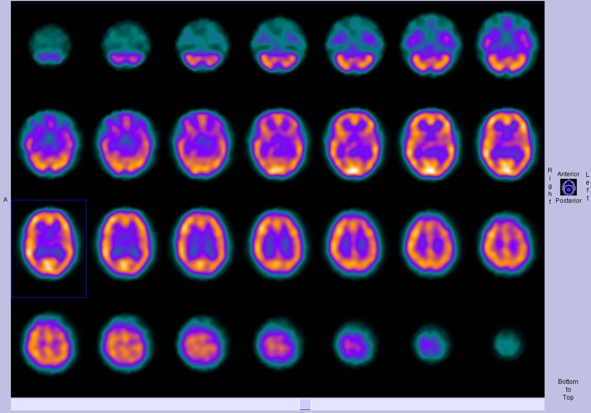 Tc-99m HMPAO or ECD brain perfusion SPECT — normal distribution