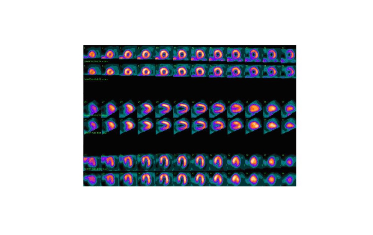 Myocardial perfusion scan — potential attenuation artifact in female patient