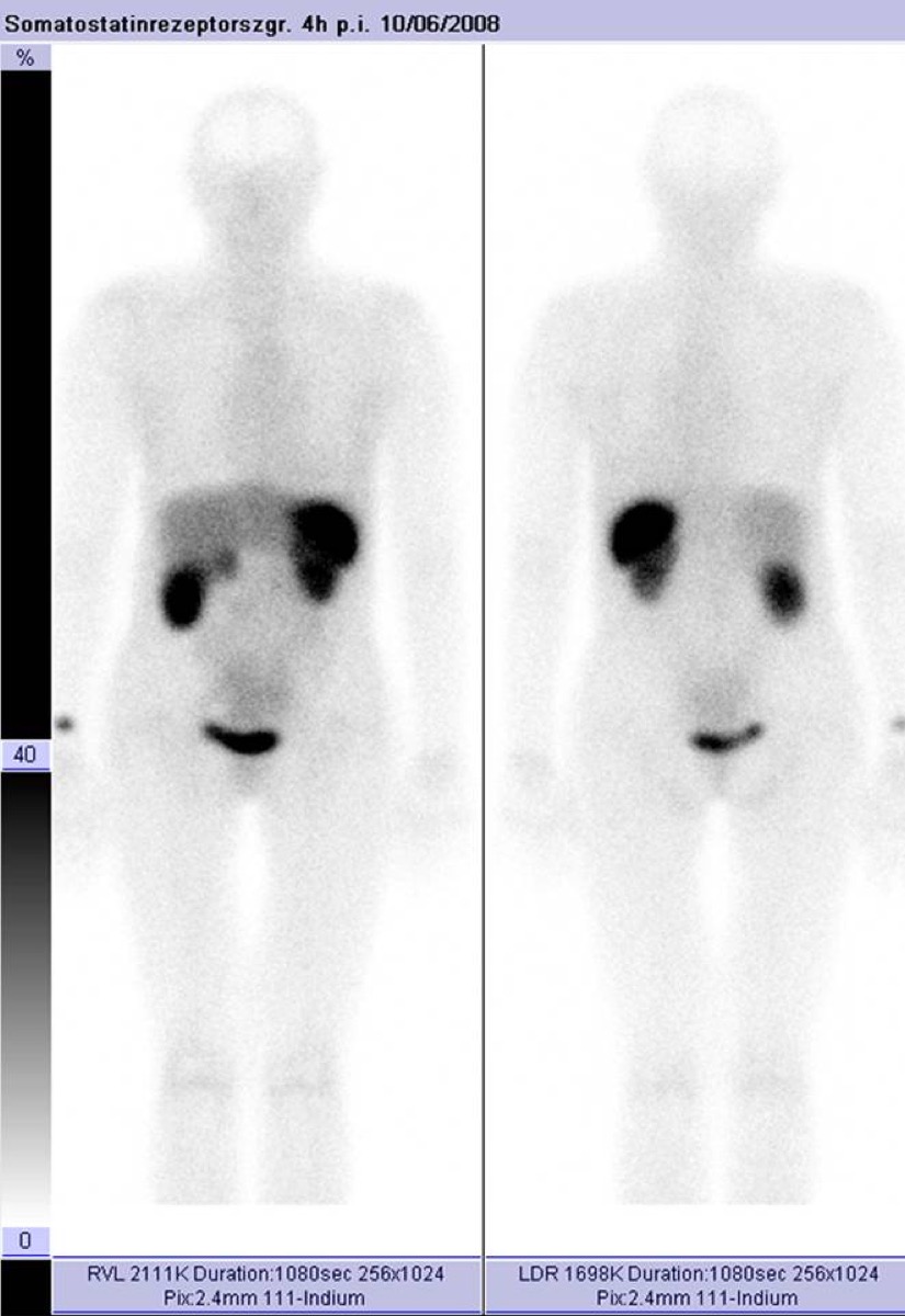 Somatostatin receptor imaging for neuroendocrine tumor
