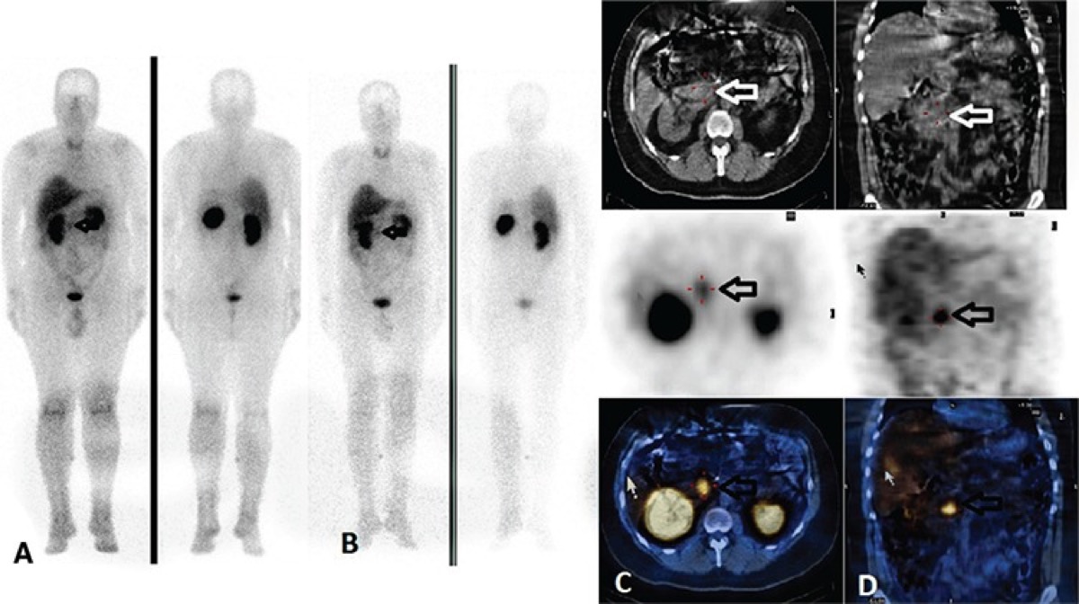 I-123 or I-131 MIBG scan — whole body images in pediatric patient