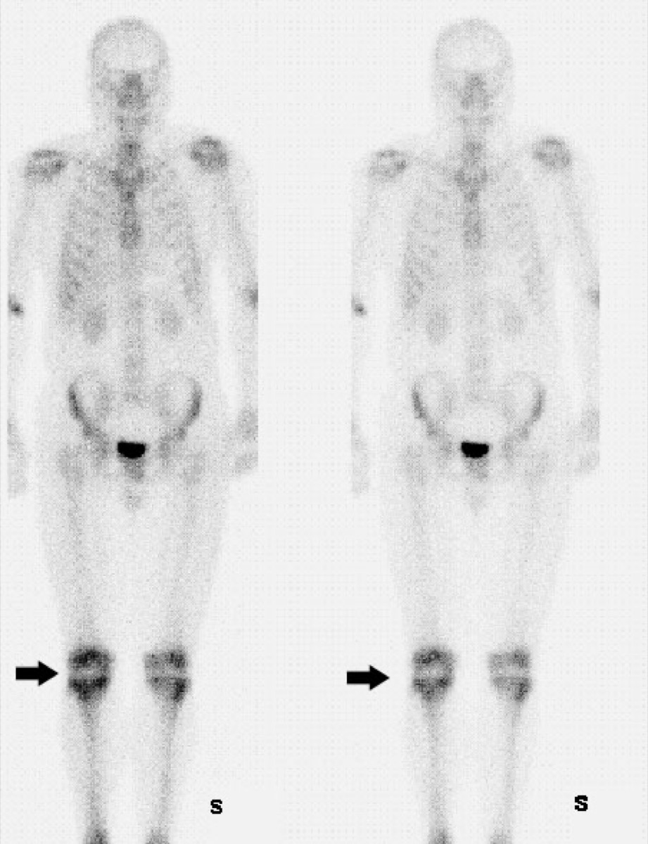Bone scan showing focal intense uptake with deformity in the femur