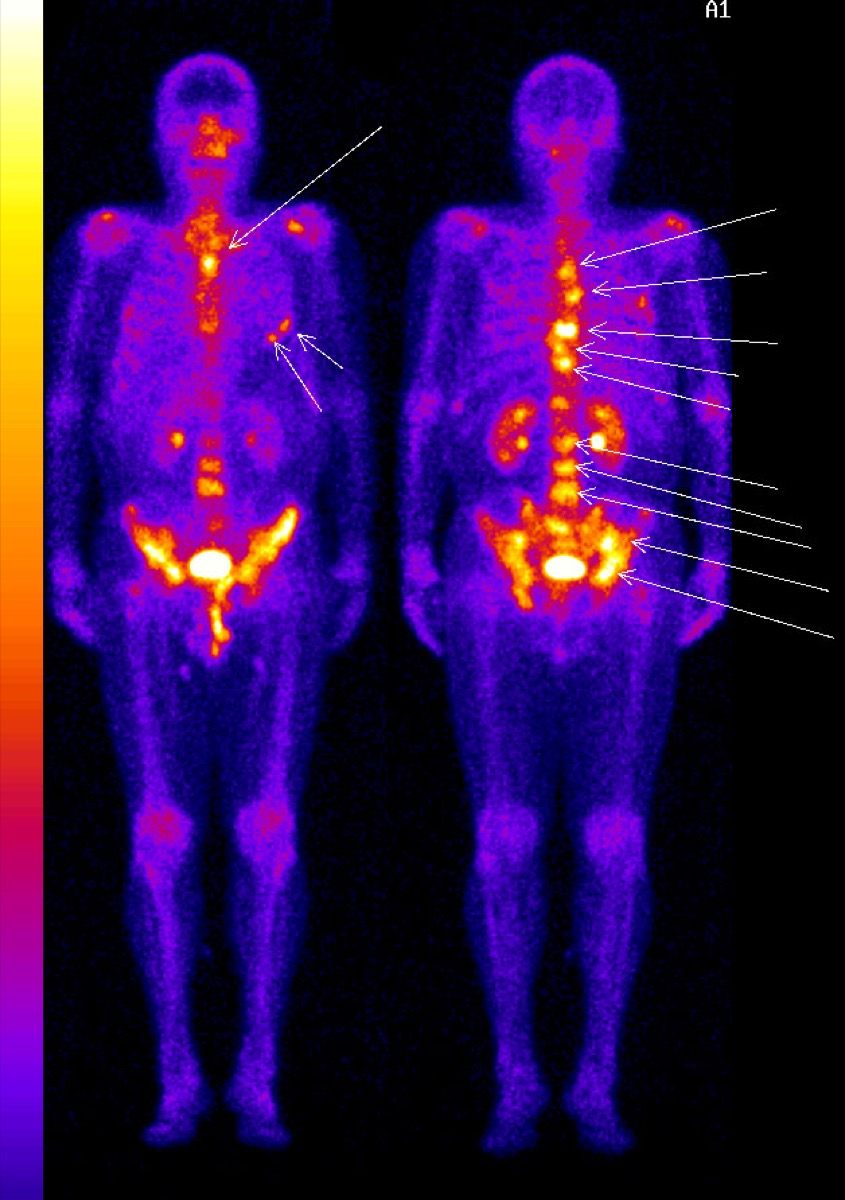 Whole-body bone scintigraphy showing diffusely increased skeletal uptake