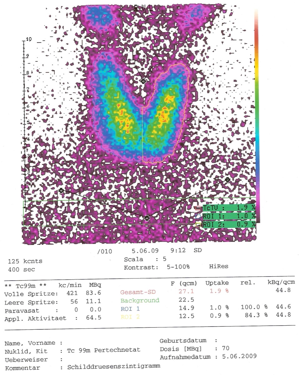 Post-ablation thyroid scan — normal physiologic distribution after thyroidectomy