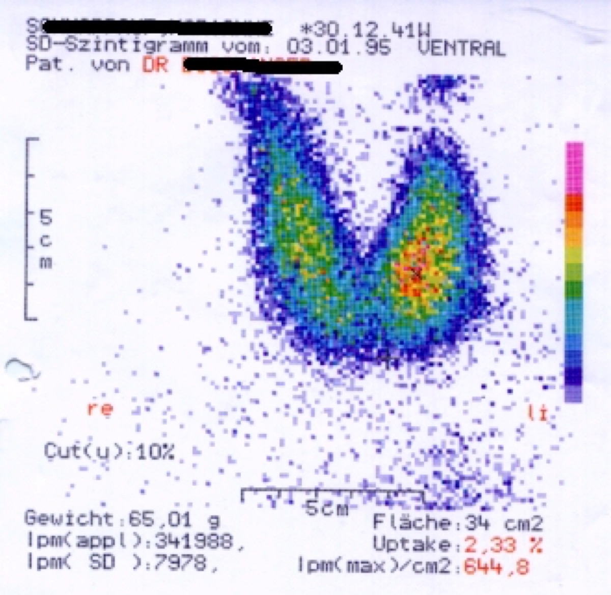 Thyroid scintigraphy following ethanol injection into a thyroid nodule