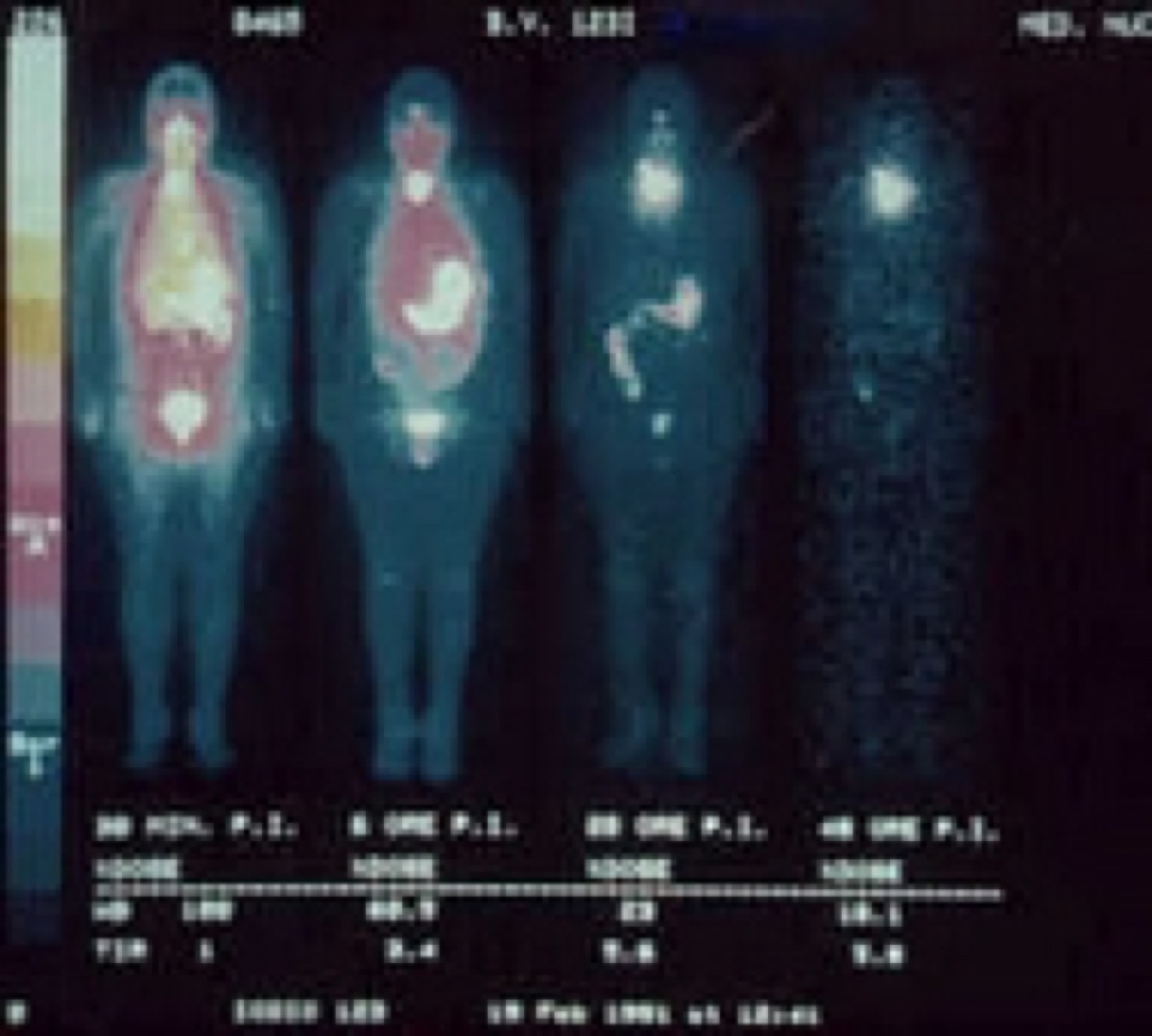 Sequential I-123 total-body scintiscans over time