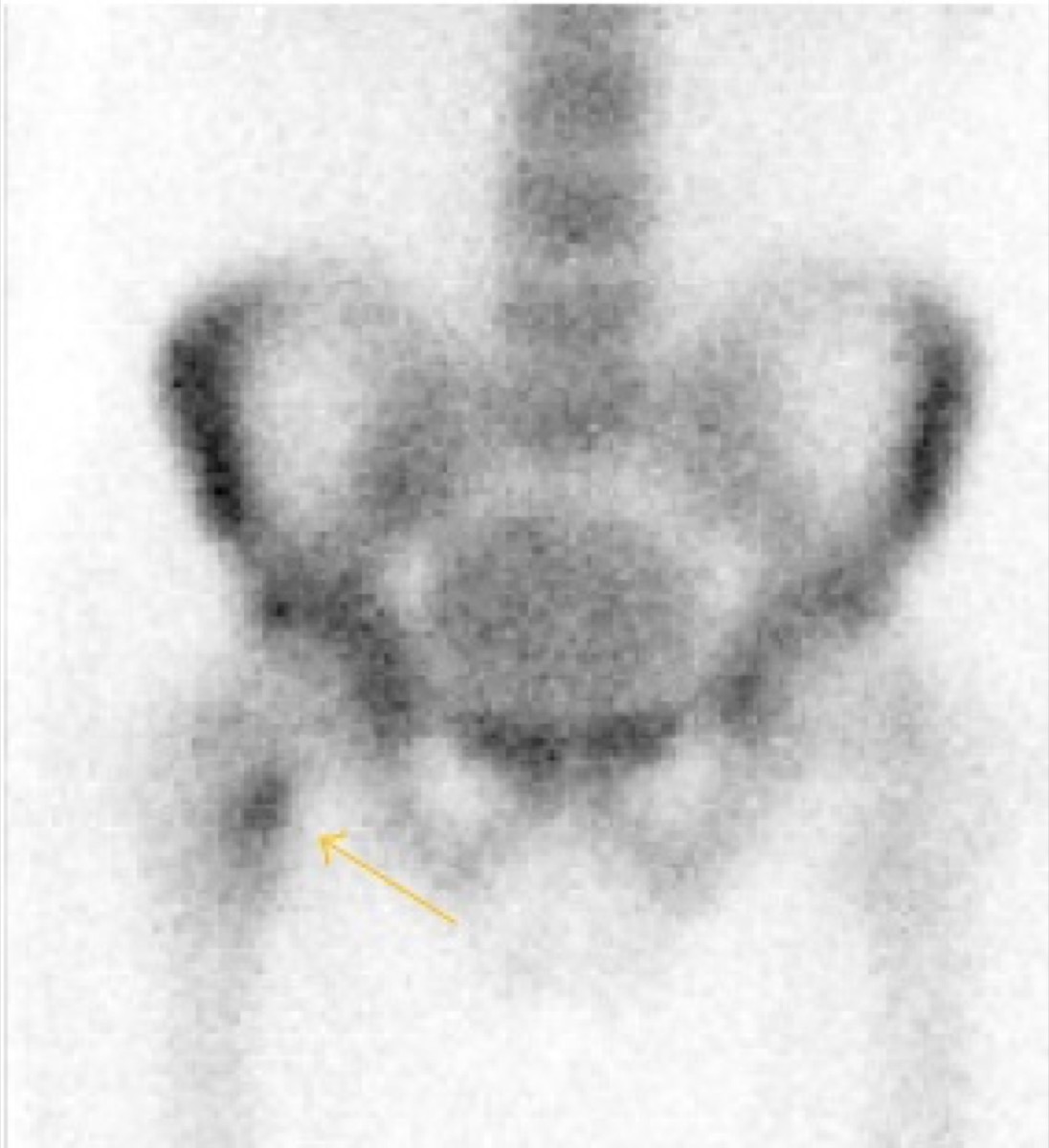 Tc-99m MDP bone scan showing uptake in the tibial region