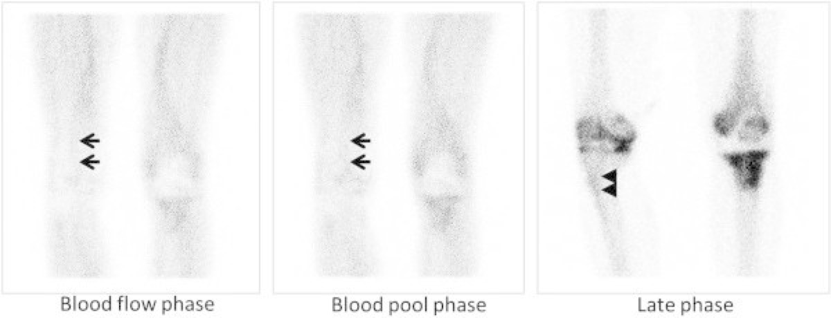 Three-phase bone scintigraphy — serial images