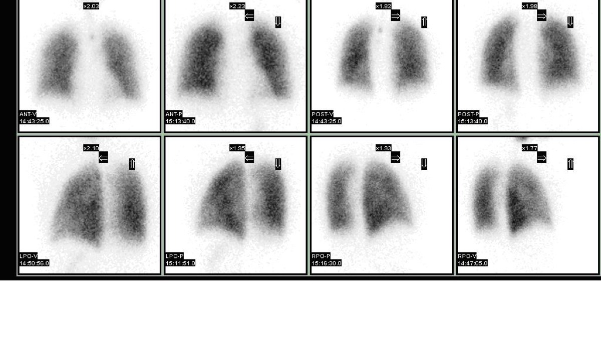 Ventilation/perfusion (V/Q) lung scan — multiple projections