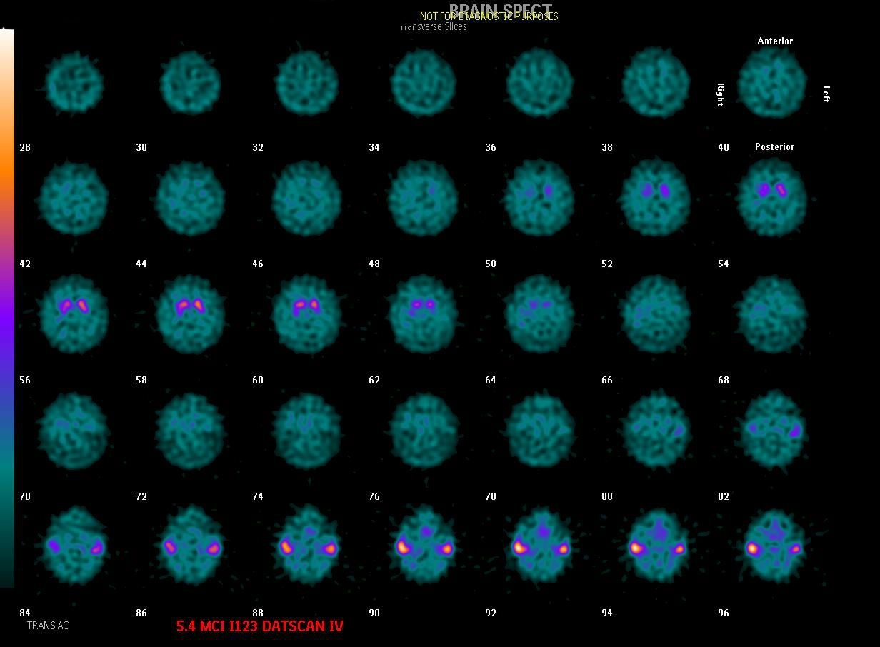 I-123 DaTSCAN SPECT (transverse slices) showing asymmetrically reduced striatal dopamine transporter uptake