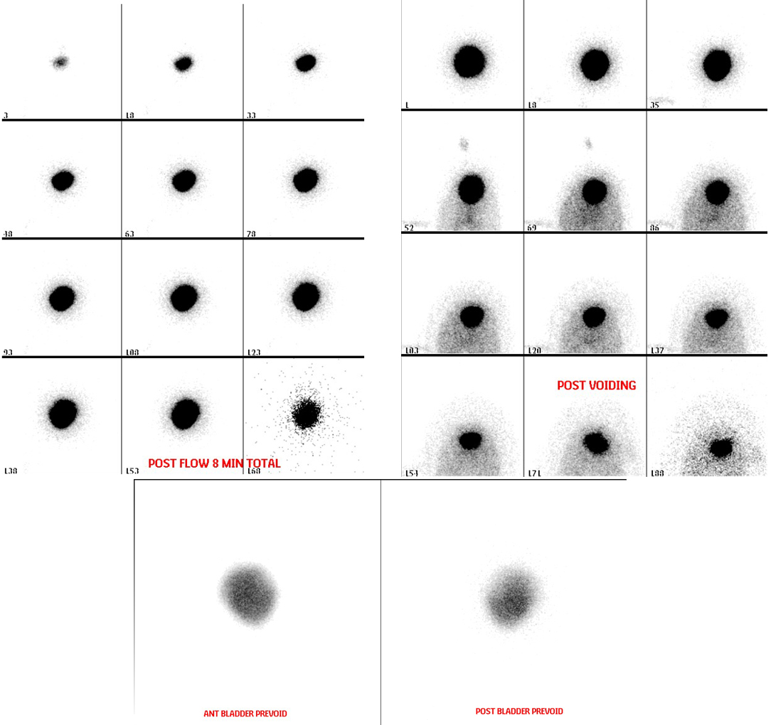 Direct radionuclide cystogram — post-flow total image and post-voiding views showing the bladder before and after urination