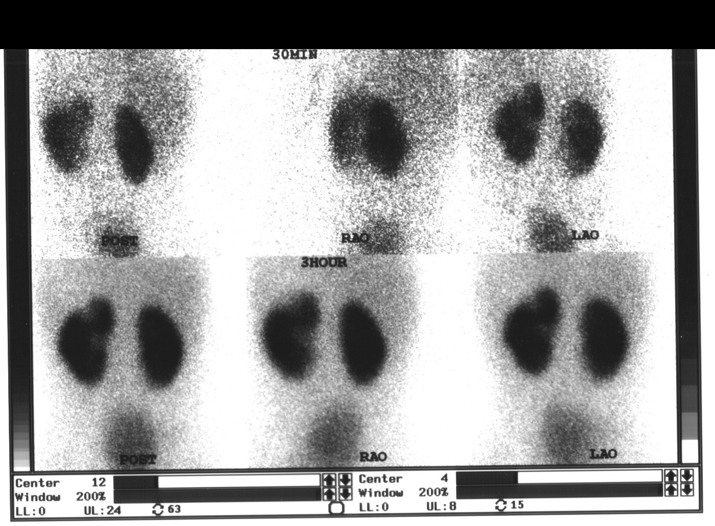 Tc-99m DMSA renal cortical scan at 30 min and 3 hours (POST, RAO, LAO views) showing focal cortical defect — renal scarring post-pyelonephritis