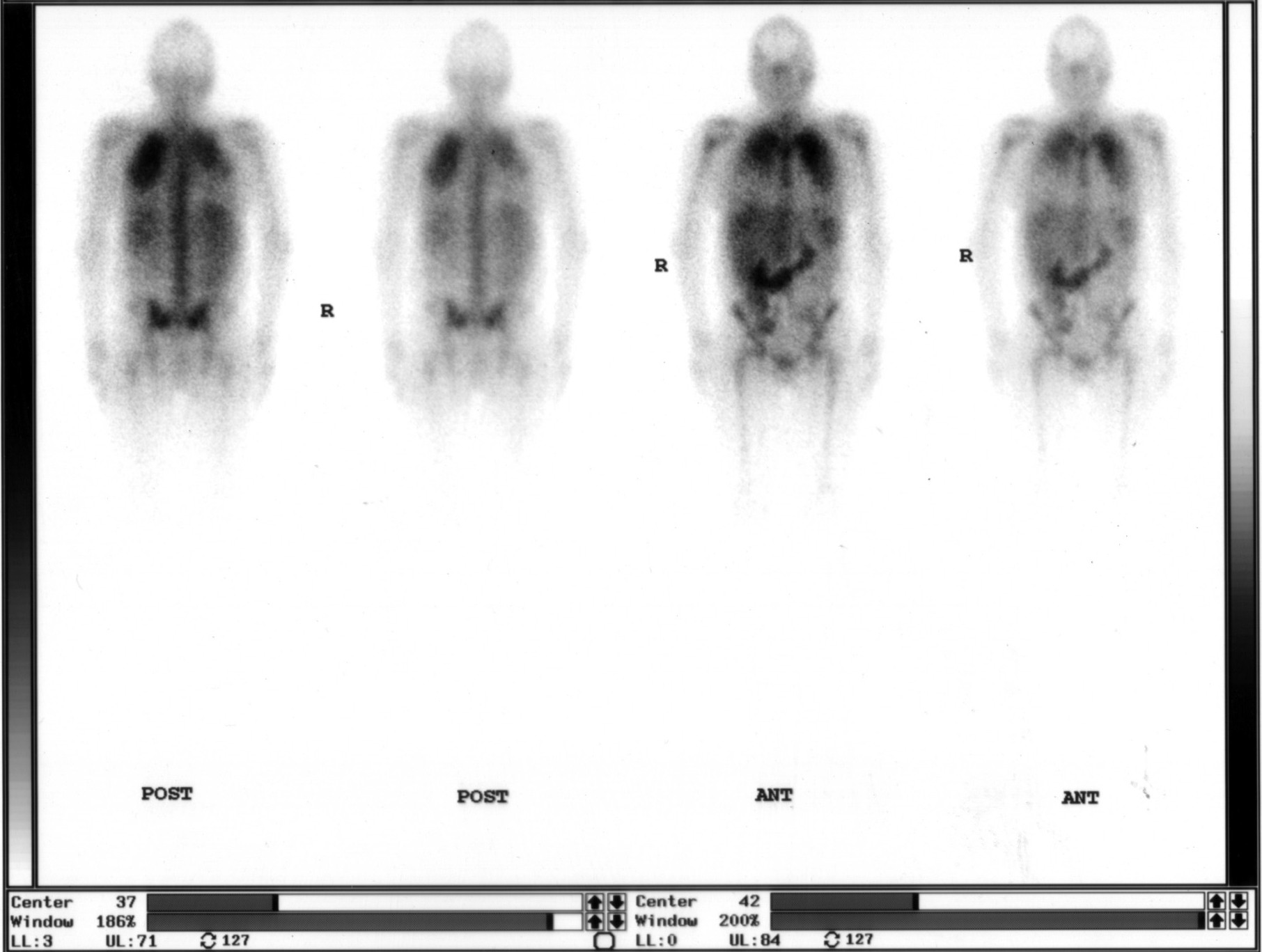 Ga-67 citrate whole-body scan: posterior and anterior views