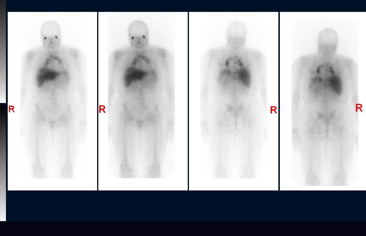 Ga-67 whole-body scan (anterior and posterior) showing bilateral symmetric hilar and mediastinal uptake — positive study for sarcoidosis