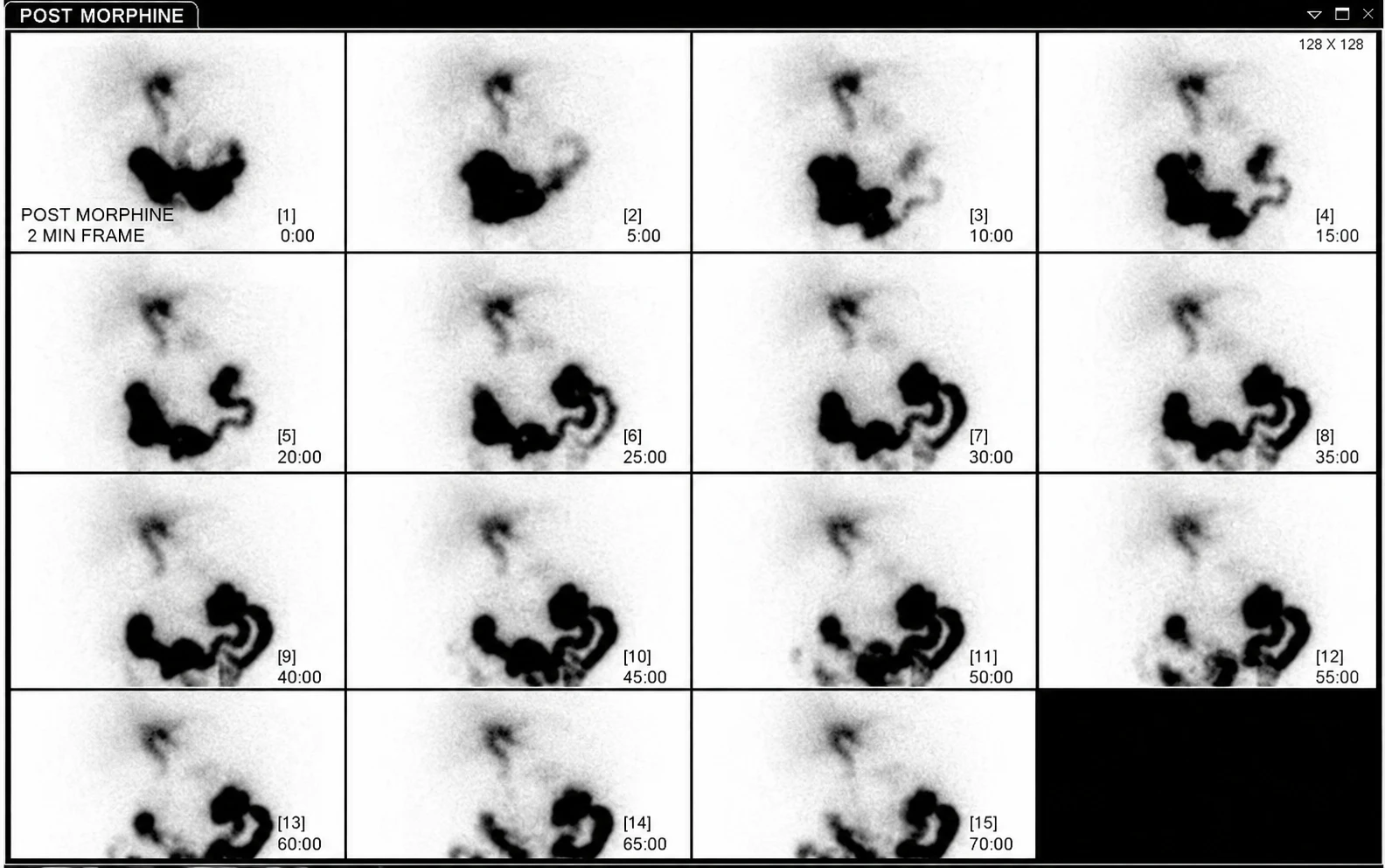 Tc-99m HIDA scan post-morphine augmentation (2-minute frames, 0–70 min) — absent gallbladder filling despite biliary excretion, consistent with acute cholecystitis