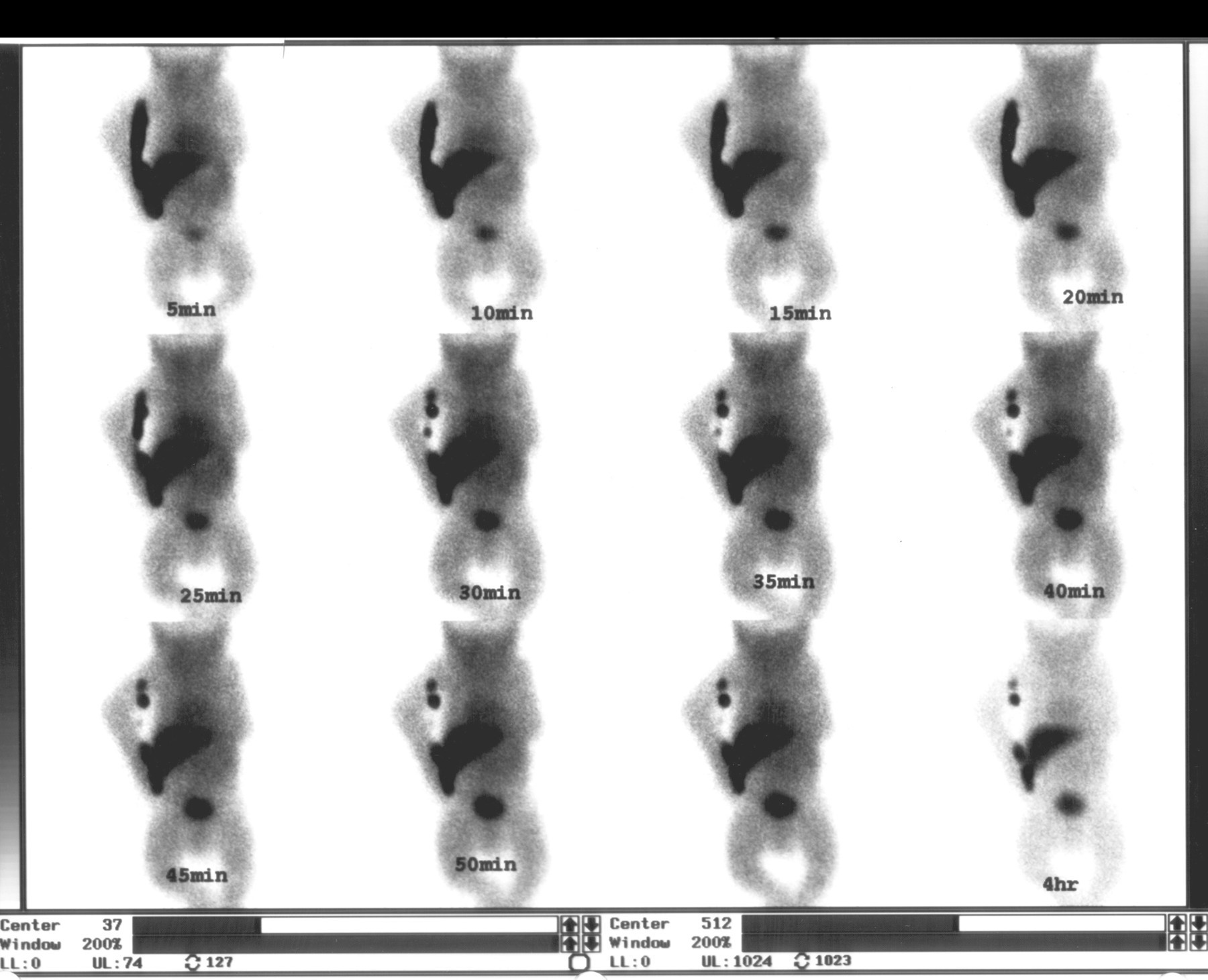 Tc-99m HIDA scan (5–50 min and 4 hr) showing hepatic uptake with absent biliary excretion into bowel — pattern of biliary atresia