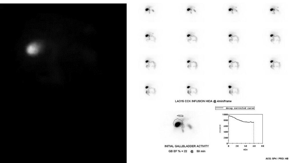 Tc-99m HIDA with CCK infusion (LAO15, 4 min/frame) — gallbladder fills but GBEF = 22% at 59 min, consistent with biliary dyskinesia