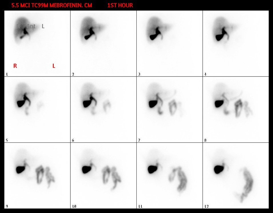 Tc-99m mebrofenin hepatobiliary scan: 12 sequential frames over the first hour