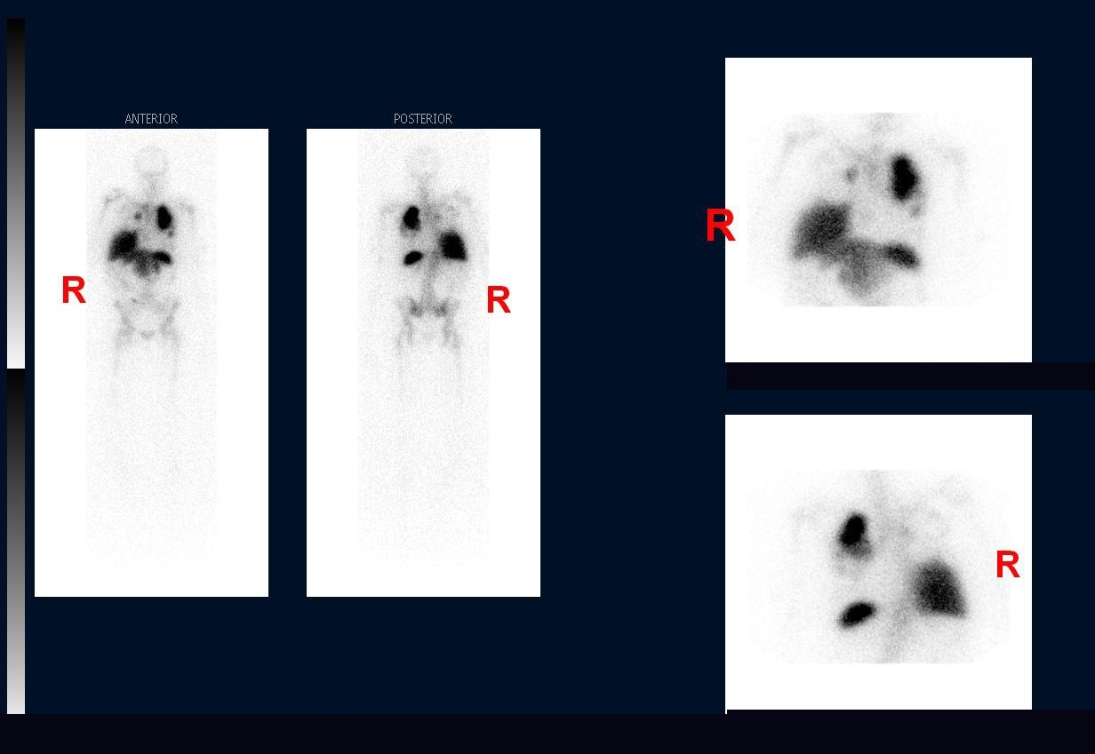 In-111 oxine WBC scan: whole-body anterior and posterior views with abdominal spot images
