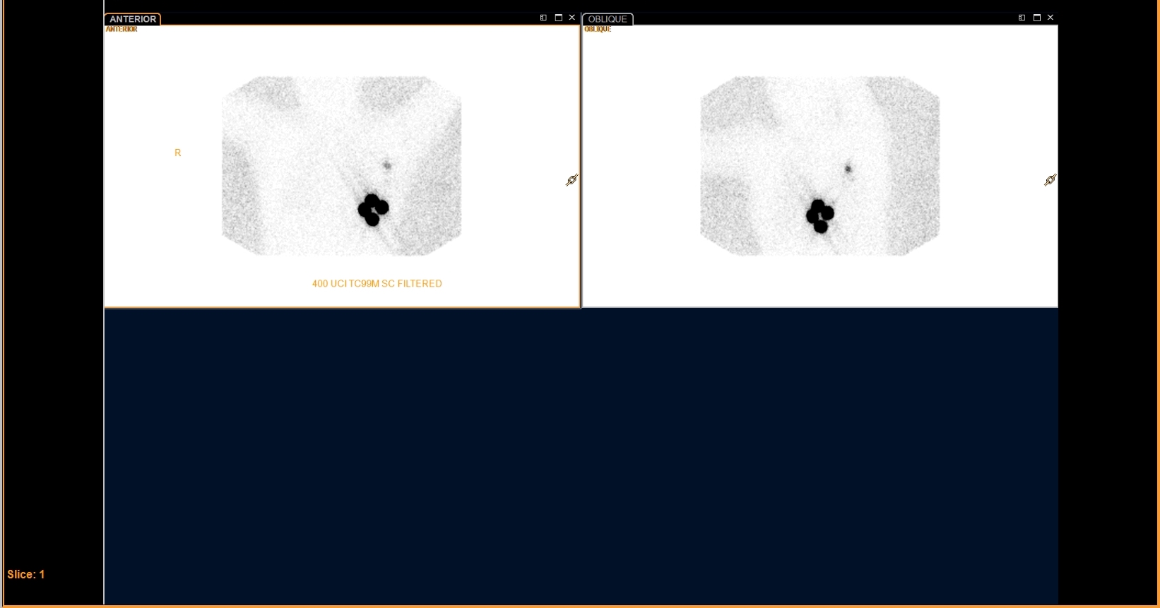 Breast lymphoscintigraphy — anterior and oblique views showing injection site and sentinel lymph node in the axilla; labeled '400 UCI TC99M SC FILTERED'