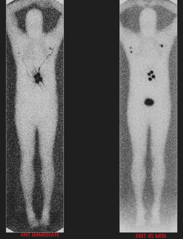 Melanoma lymphoscintigraphy — 45-minute delayed image showing sentinel lymph nodes appearing in more than one draining basin from a truncal melanoma
