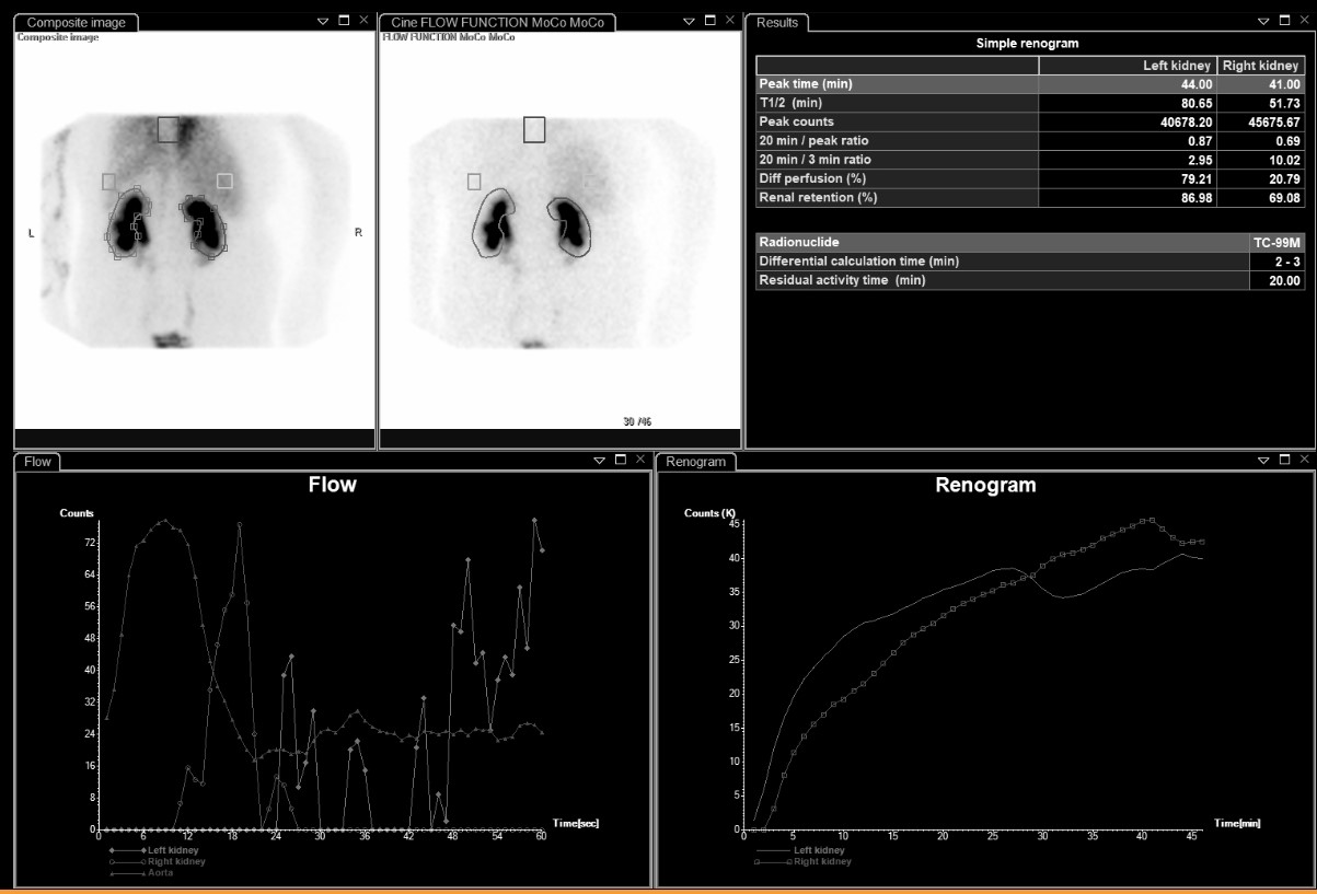 Tc-99m MAG3 renal scan — composite image, flow curve, renogram curves, and quantitative results showing bilateral abnormal drainage with asymmetric differential function