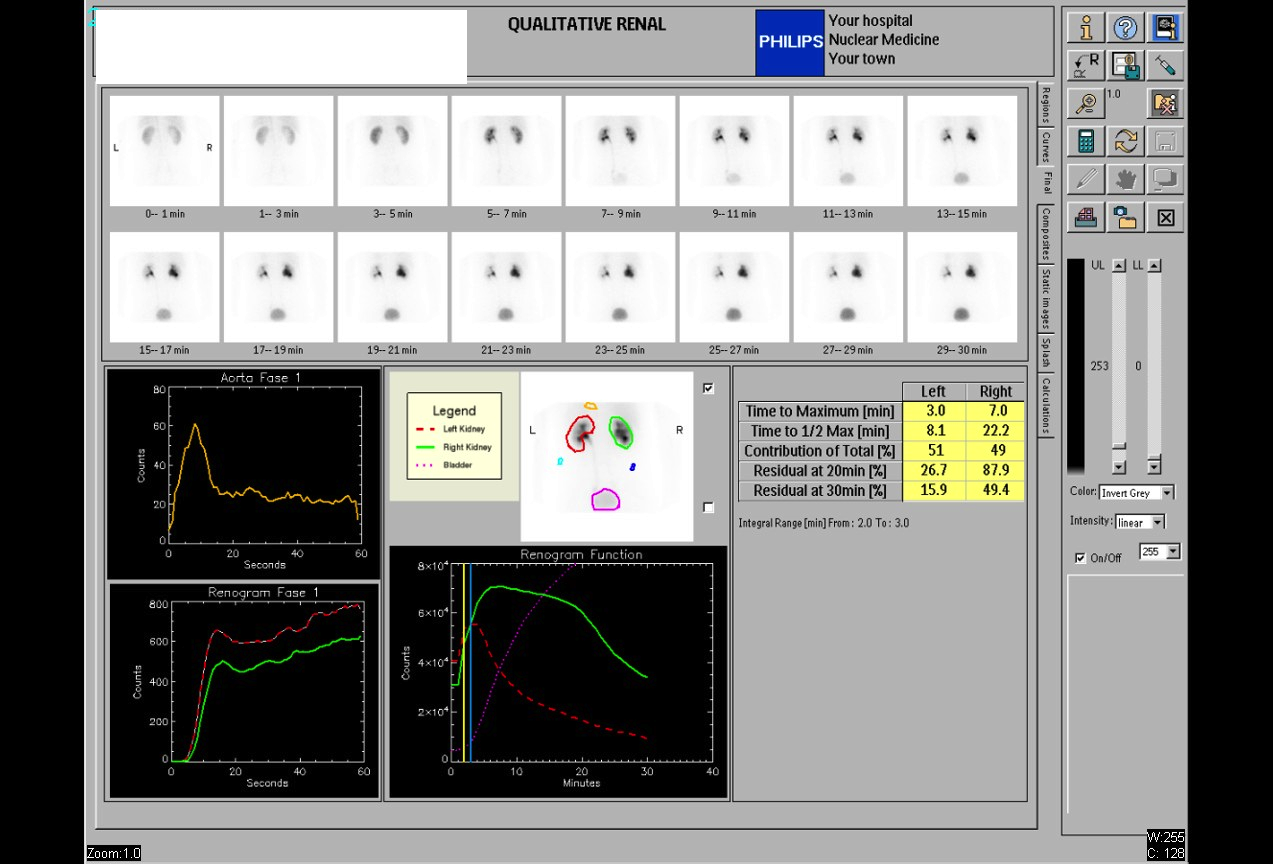 Tc-99m MAG3 qualitative renal scan (0–30 min sequential images) with renogram curves and quantitative parameters for both kidneys