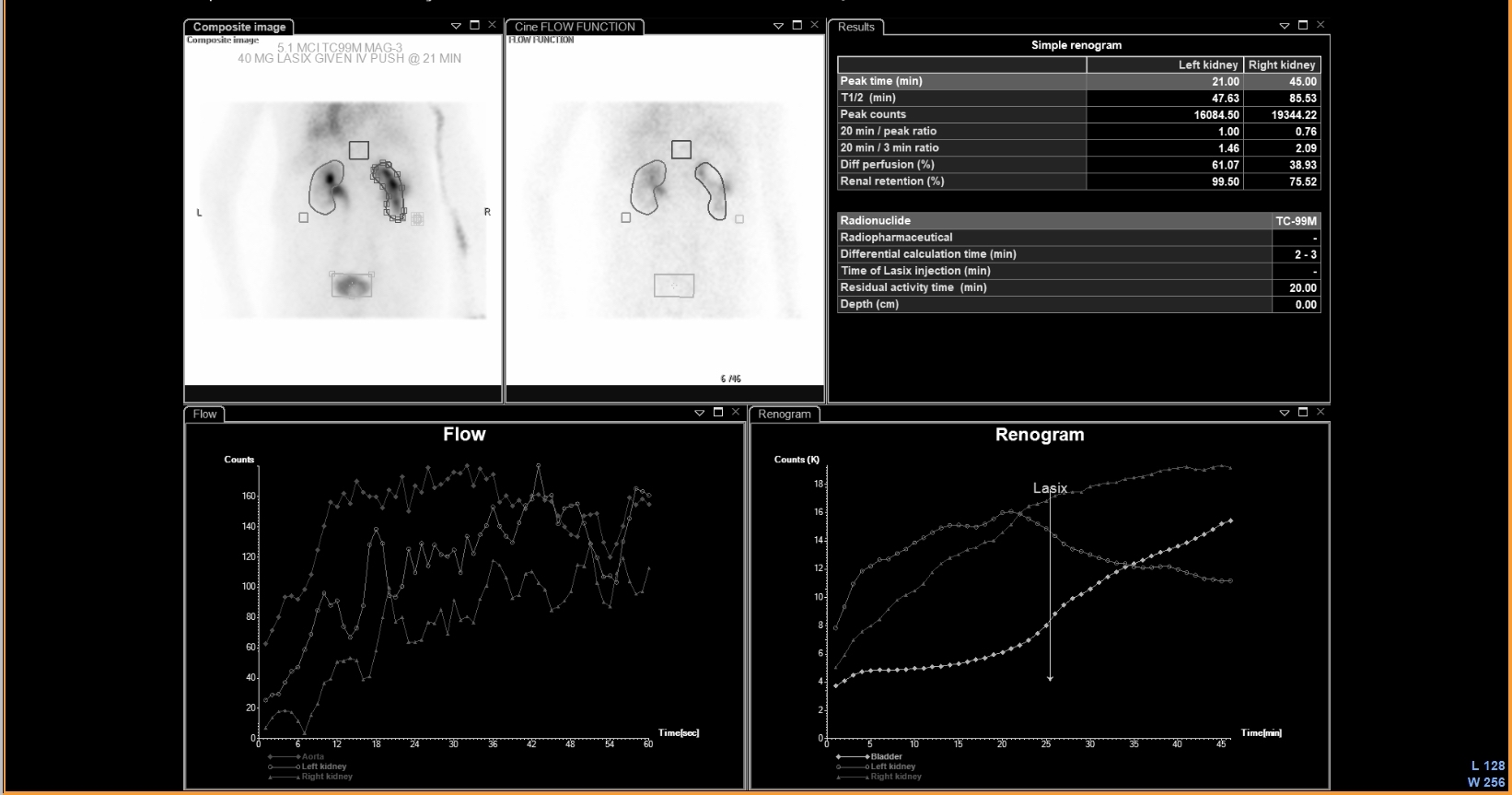 Tc-99m MAG3 diuretic renogram with Lasix at 21 min — right kidney shows prolonged T½ (85.53 min) with persistent tracer retention and rising renogram curve post-furosemide, indicating UPJ obstruction