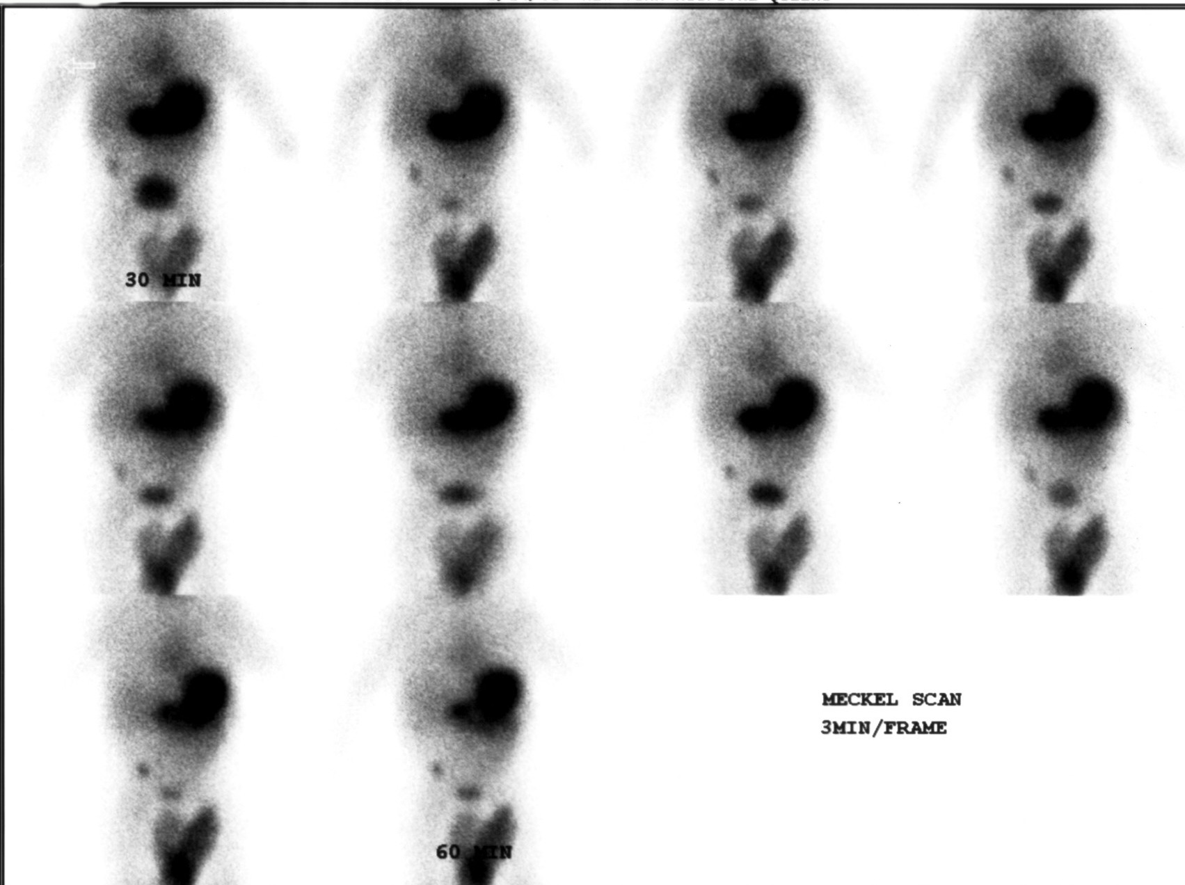 Dynamic abdominal scan: sequential frames at 3 min/frame from 30 to 60 minutes post-injection
