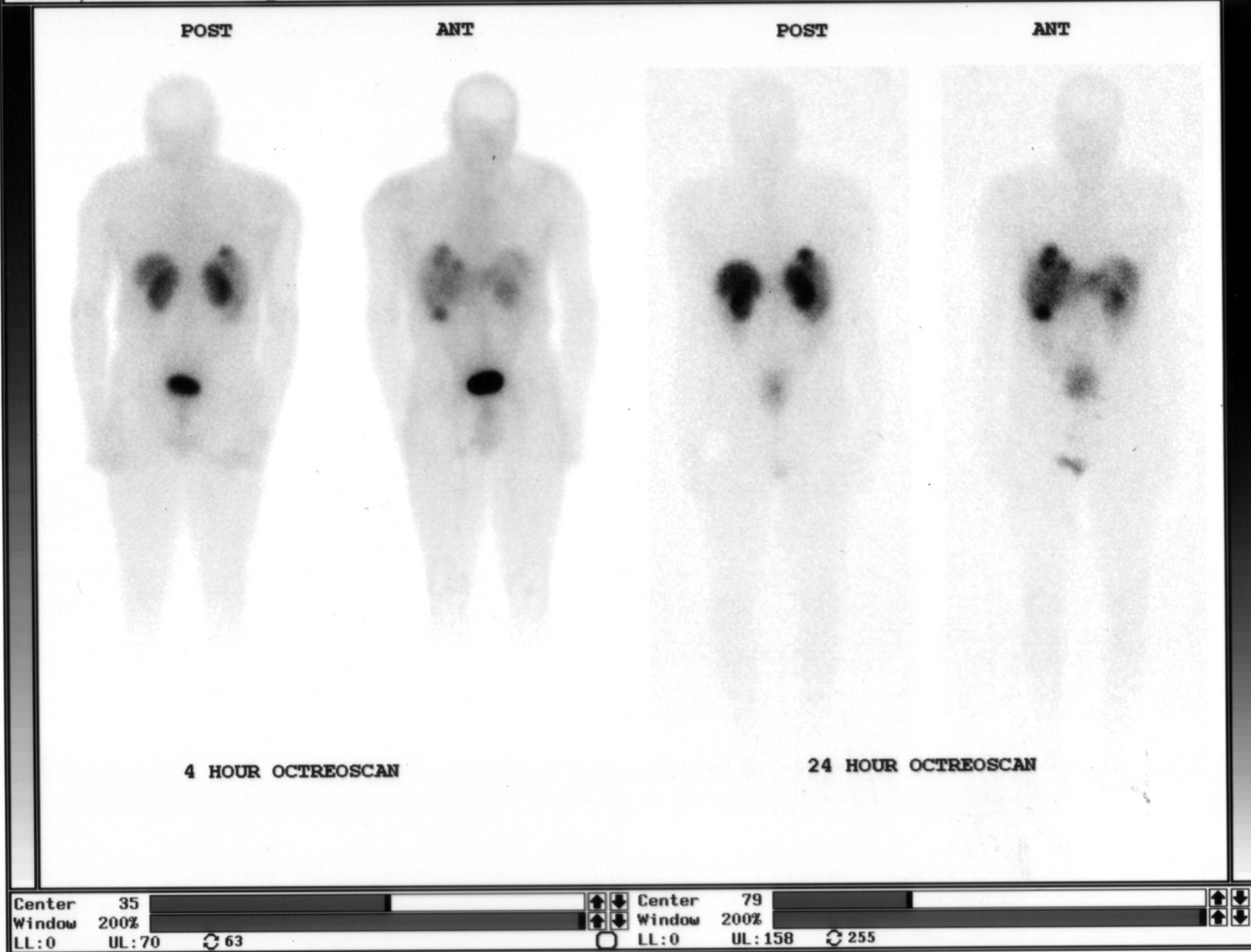 In-111 pentetreotide (Octreoscan): 4-hour and 24-hour whole-body anterior and posterior images