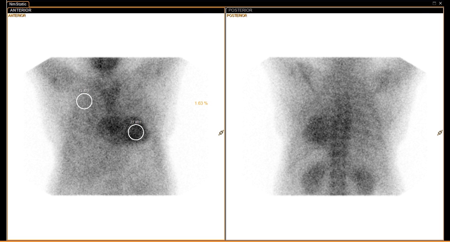 Tc-99m PYP scan: anterior and posterior chest views with ROI measurements and H/CL ratio of 1.63