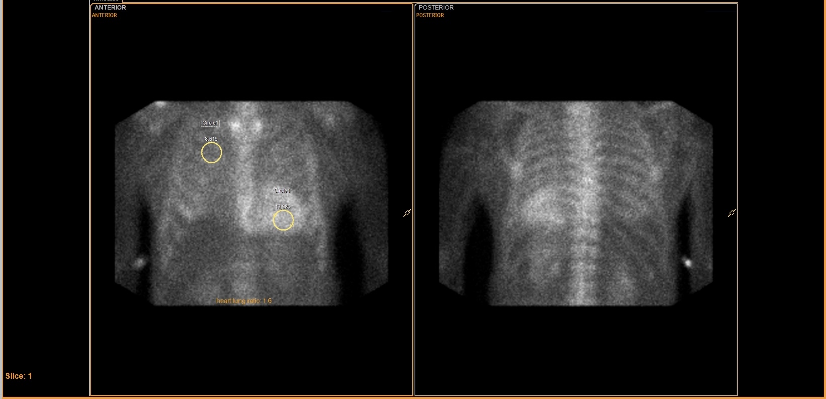 Tc-99m PYP scan: anterior and posterior chest views with ROI circles and heart-to-lung ratio of 1.6
