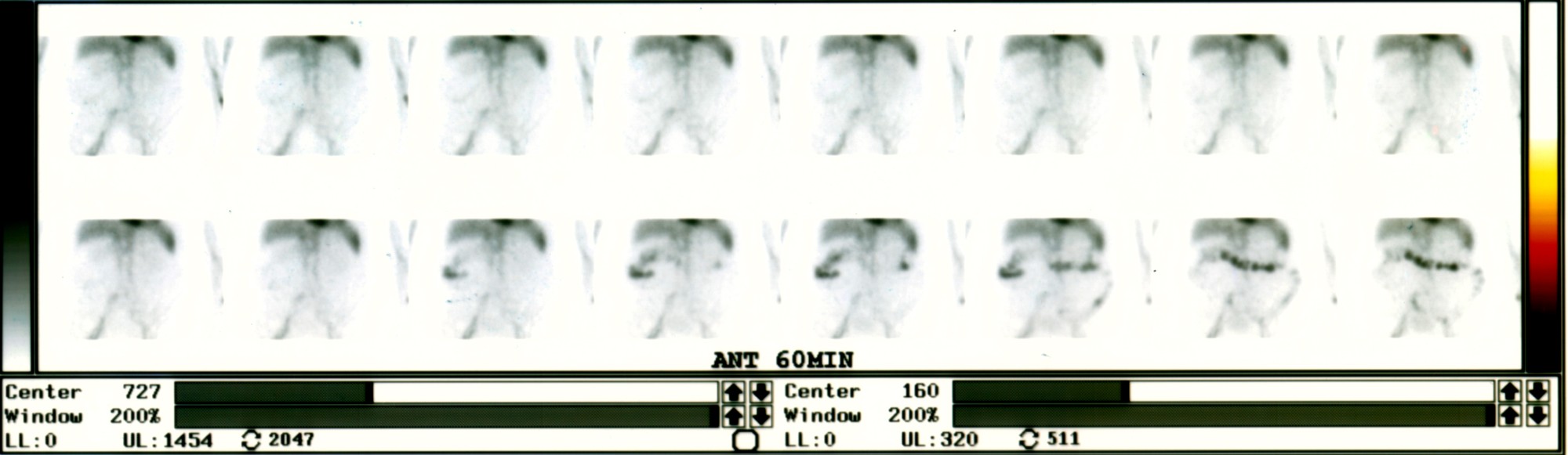 Tc-99m RBC scan (ANT 60 min, sequential frames) — focal activity appearing in the right lower quadrant and migrating along the colon, indicating active GI hemorrhage