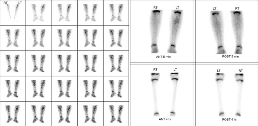 Three-phase bone scan showing increased flow/blood pool in soft tissues with normal delayed bone uptake — pattern of cellulitis
