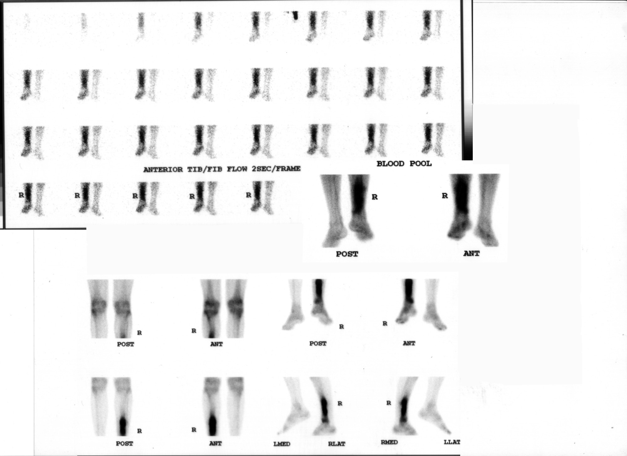 Three-phase bone scan: flow, blood pool, and delayed images of the lower extremity